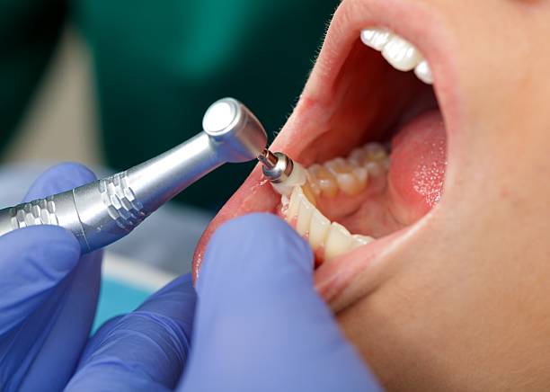 Best Dental Fillings (Composite and Amalgam)  in Paradise, CA